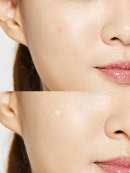 COSRX Acne Pimple Master Patch | Blemish Hydrocolloid Patch
