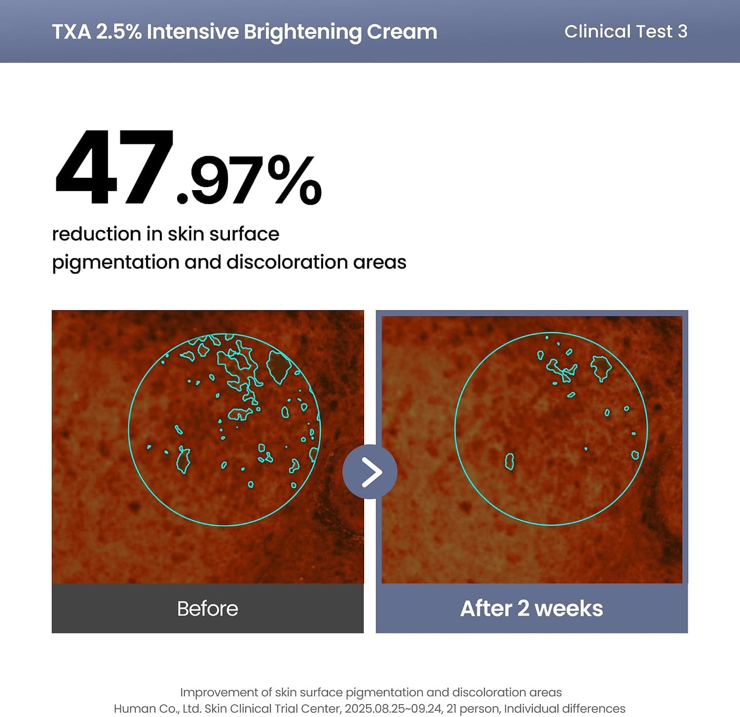 AXIS-Y TXA 2.5% Intensive Brightening Cream | Dark Spot & Post-Acne Mark Treatment