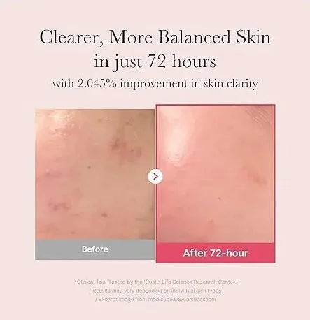 Promotional graphic for a skincare product showing a before-and-after skin comparison. The text at the top reads 'Clearer, More Balanced Skin in just 72 hours' with 'Before' on a gray label and 'After 72-hour' on a pink label.